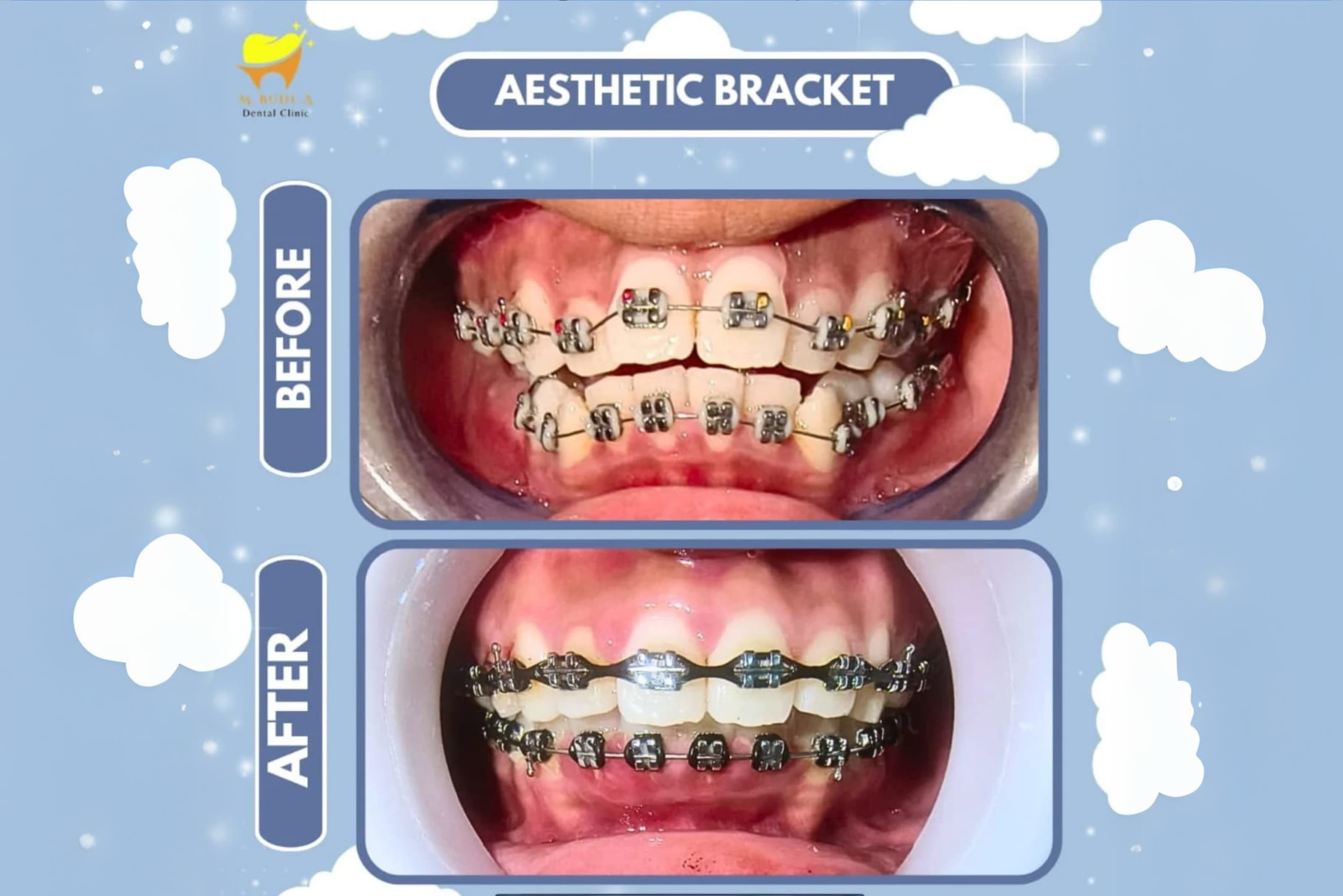 Before After Behel