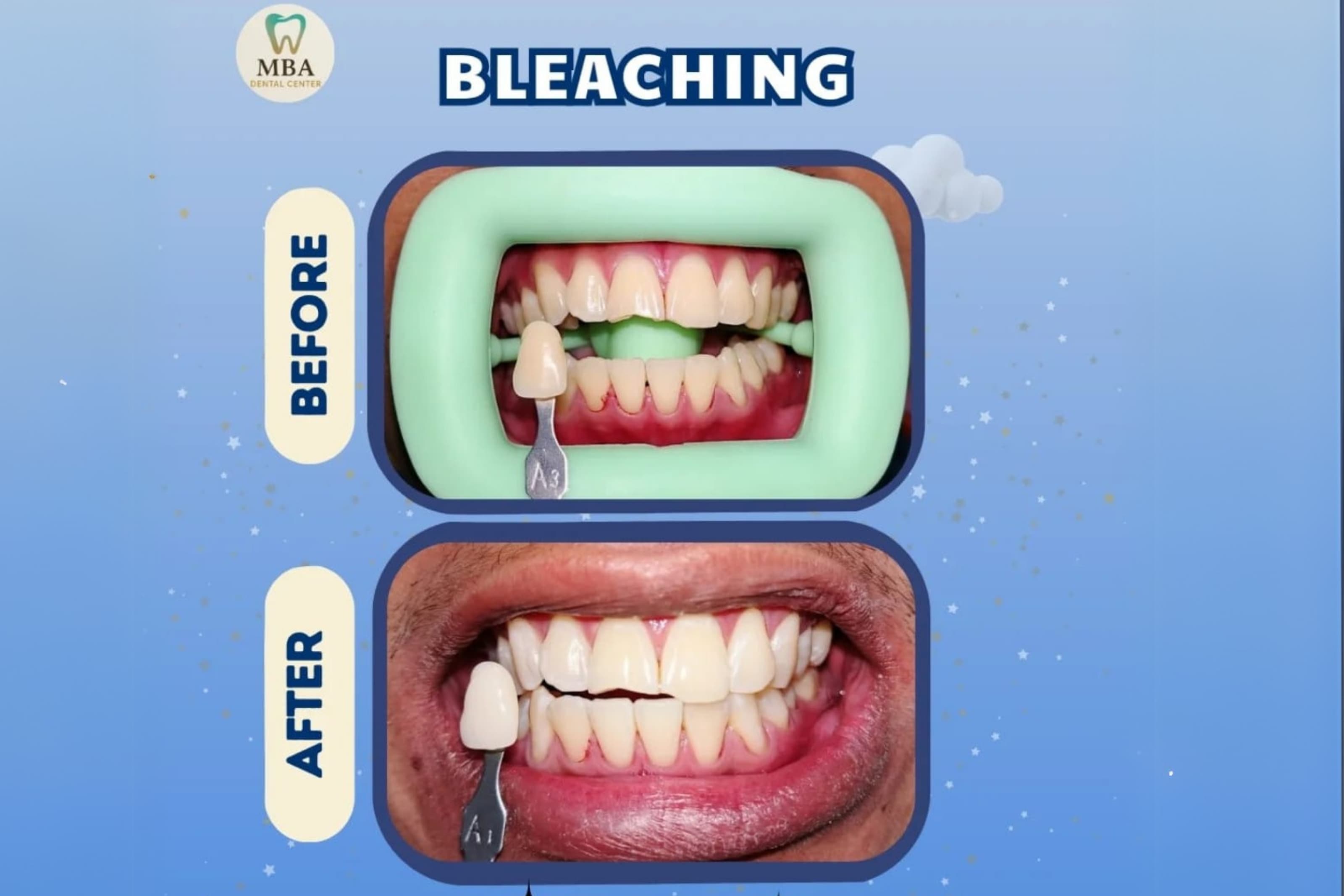 Before After Behel