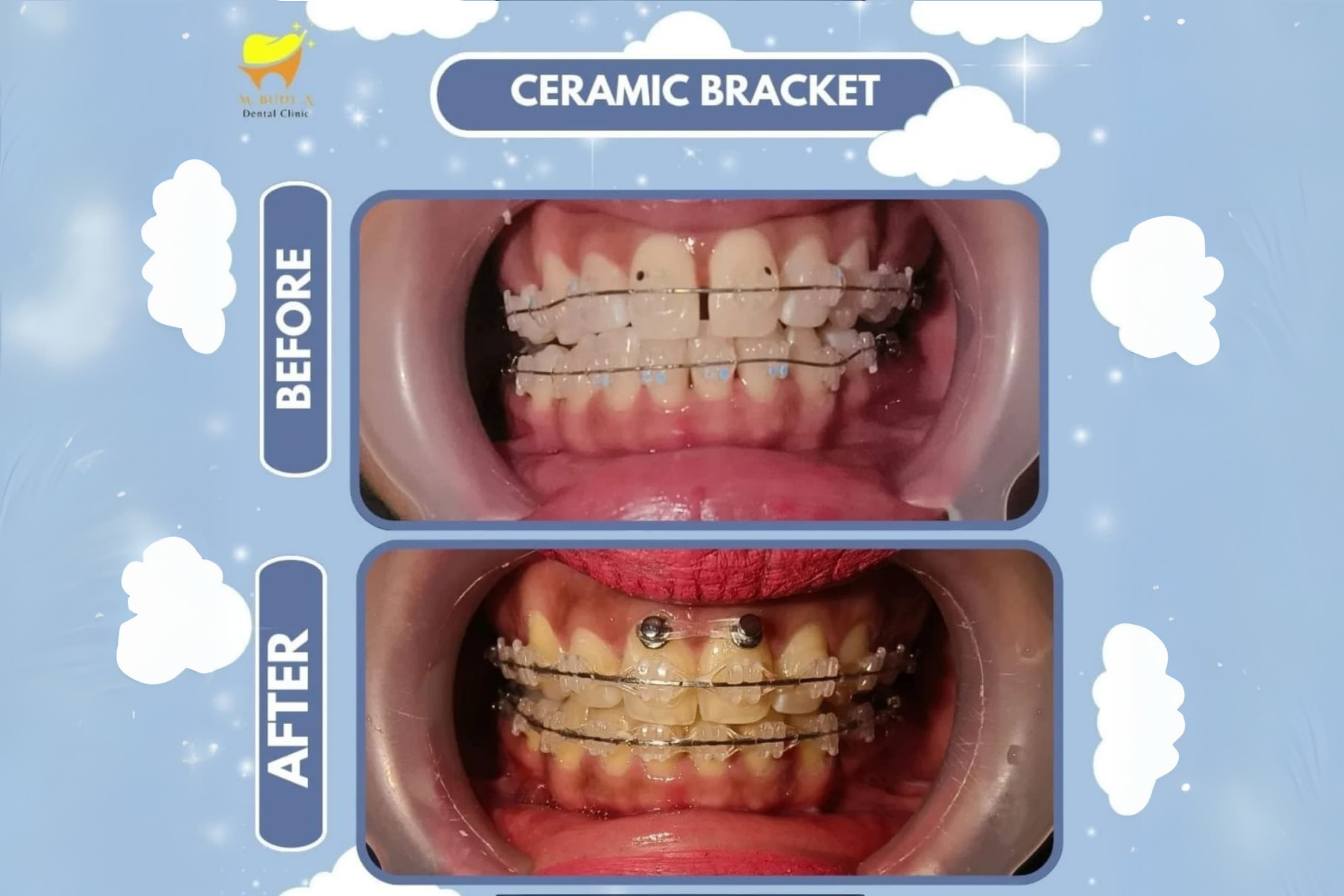 Before After Behel
