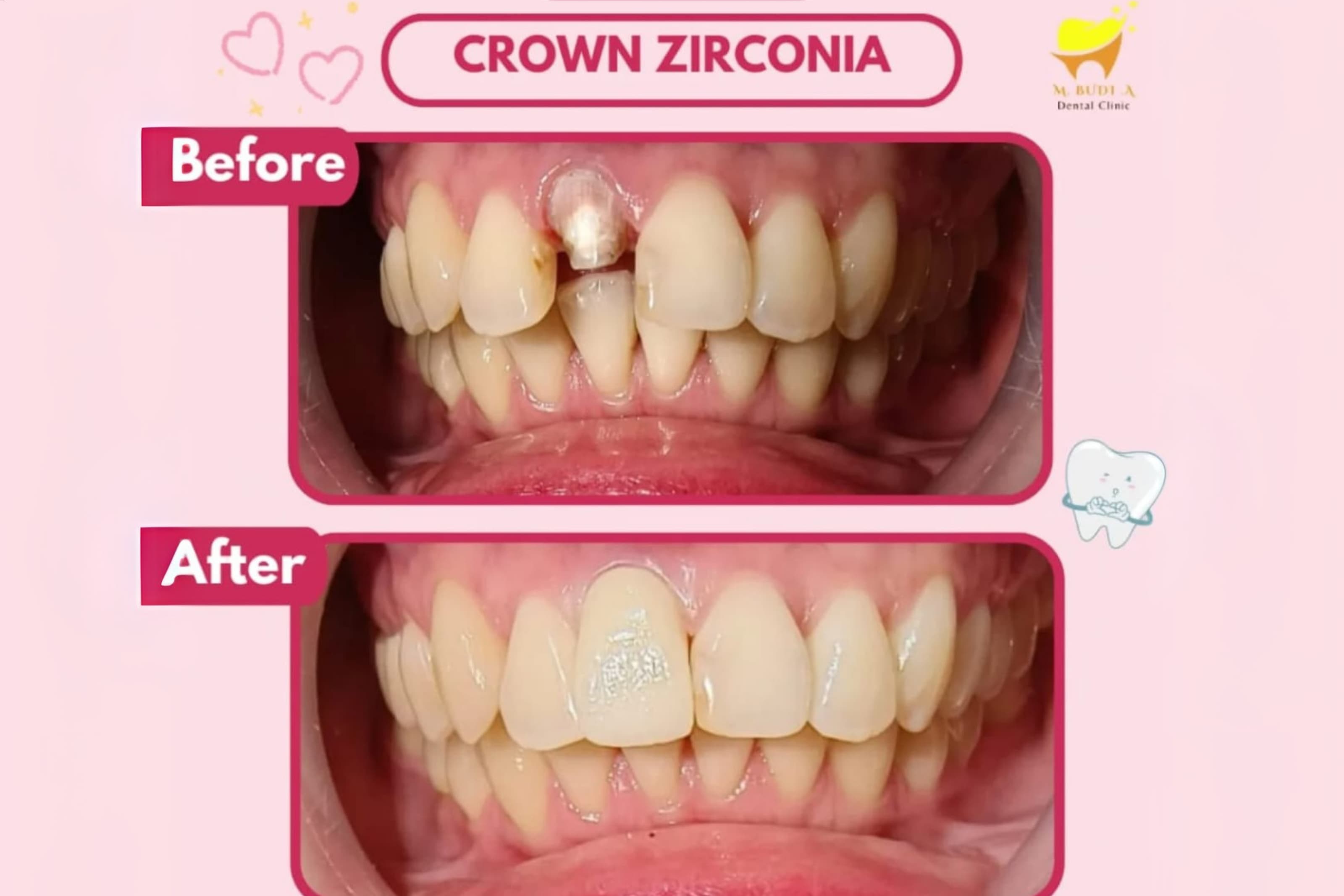 Before After Behel