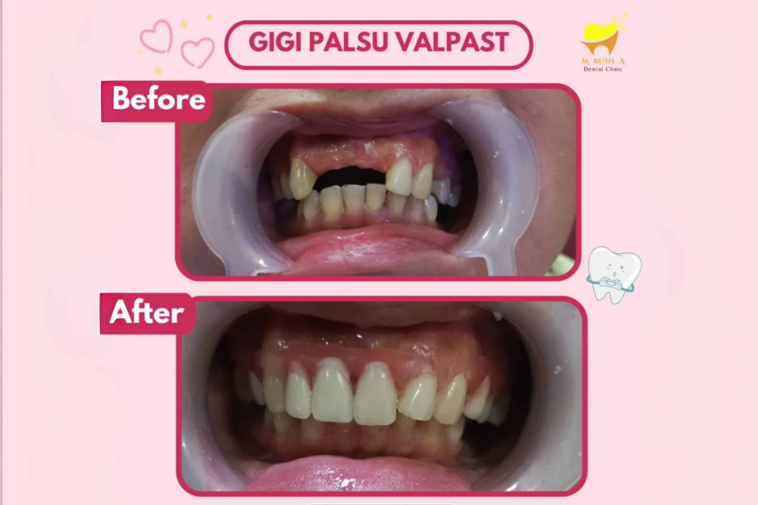Before After Behel
