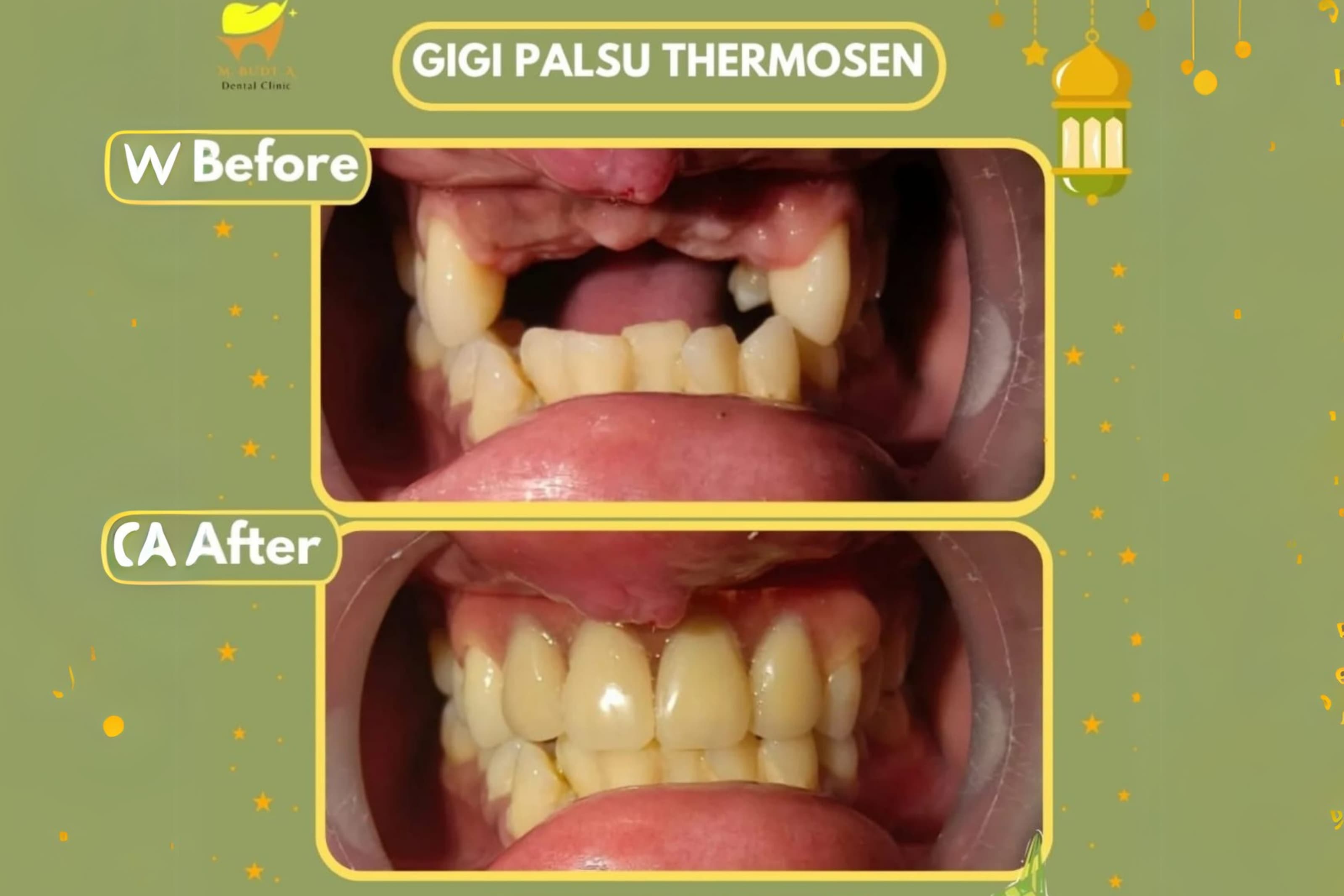 Before After Behel