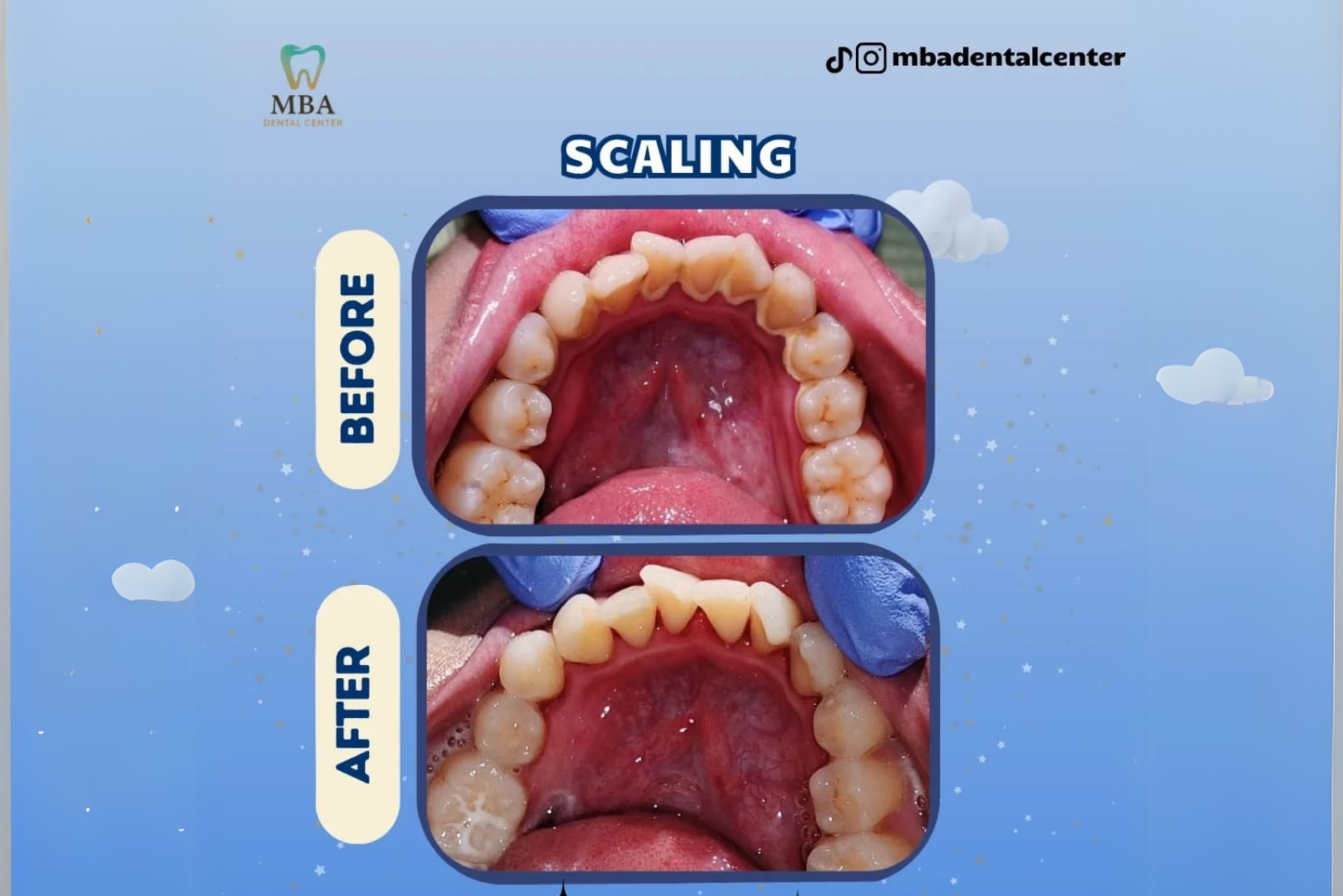 Before After Behel
